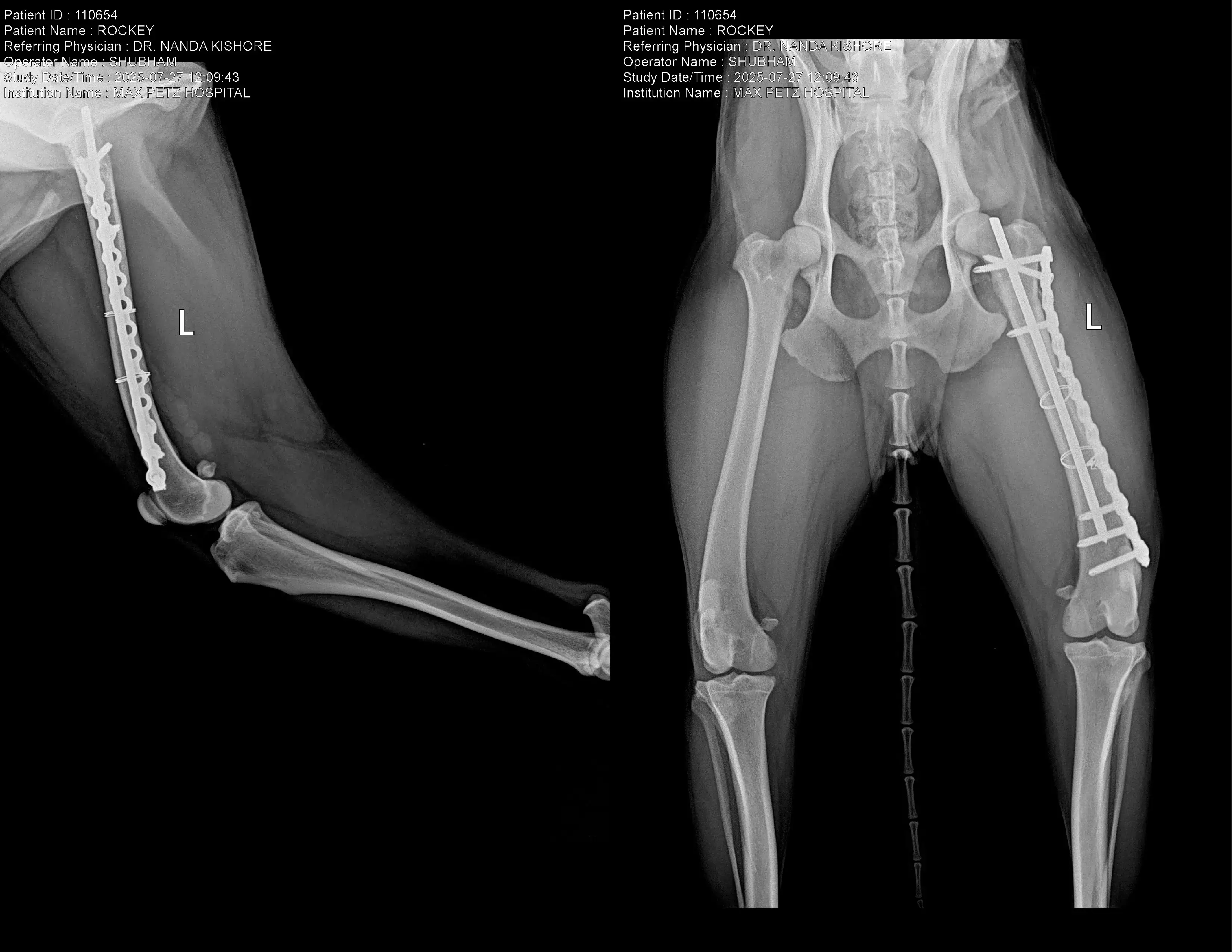 x ray Femur Diaphyseal Fracture Repair